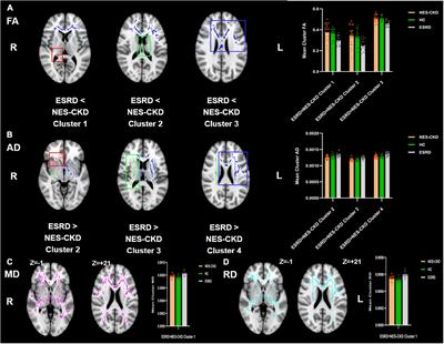 Reduced White Matter Integrity in Patients With End-Stage and Non-end-Stage Chronic Kidney Disease: A Tract-Based Spatial Statistics Study